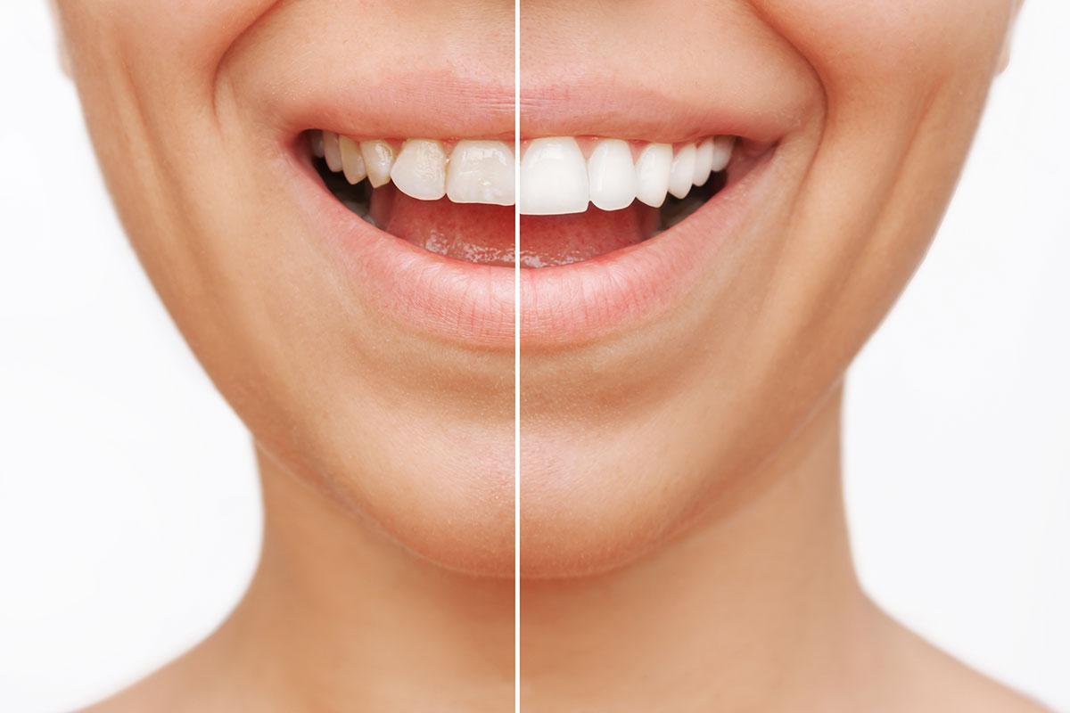 Unveiling the Benefits of Veneers: A Smile Transformation