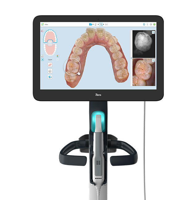 Can you use an intraoral scanner for upper jaw impressions