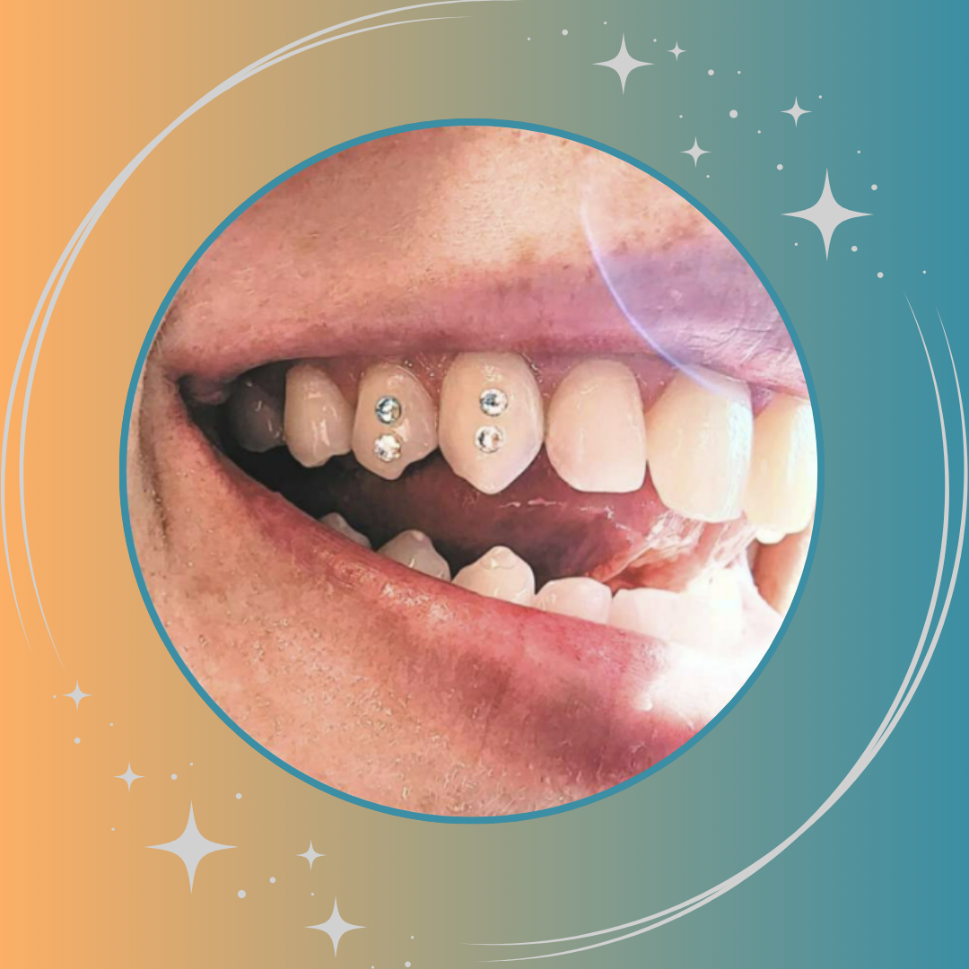 tooth gems placement by Irvine dentist Joanna Jefferson, DDS