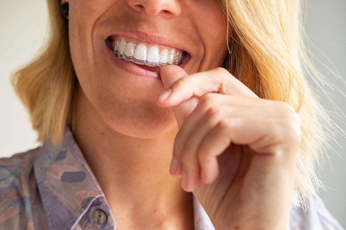 The Technology Behind Invisalign Clear Aligners at Tooth Love