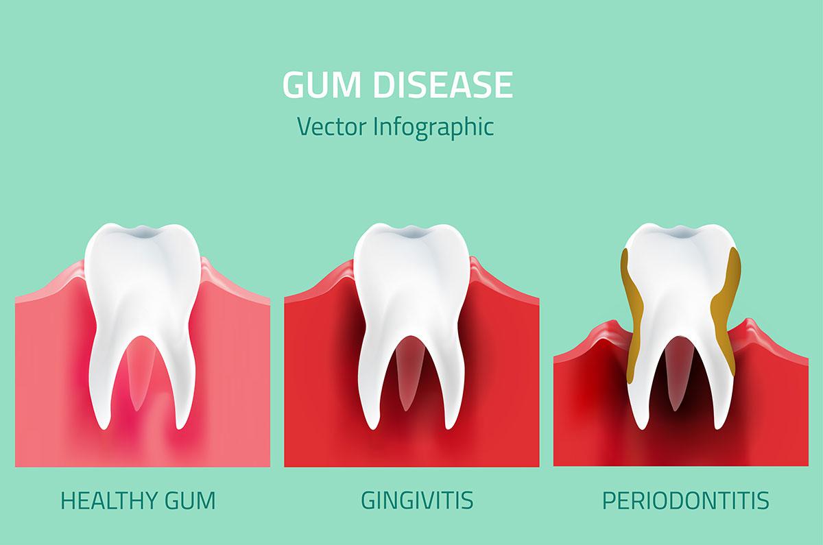 Understanding Gum Health: Prevention and Treatment of Gum Disease